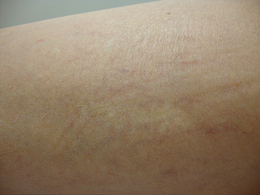 Photo of spider veins on thigh after Sclerotherapy