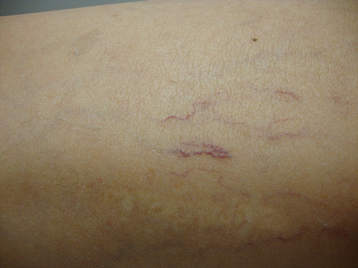 Photo of spider veins on thigh before Sclerotherapy