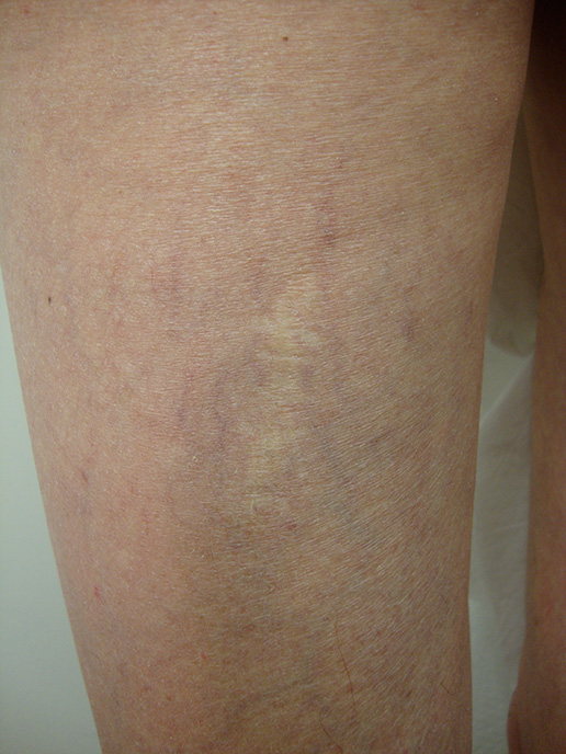 Photo of spider veins on thigh after Sclerotherapy