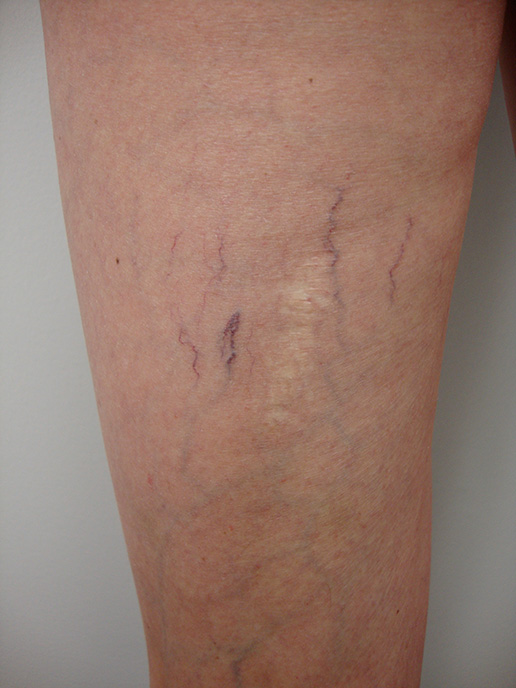 Photo of spider veins on thigh before Sclerotherapy