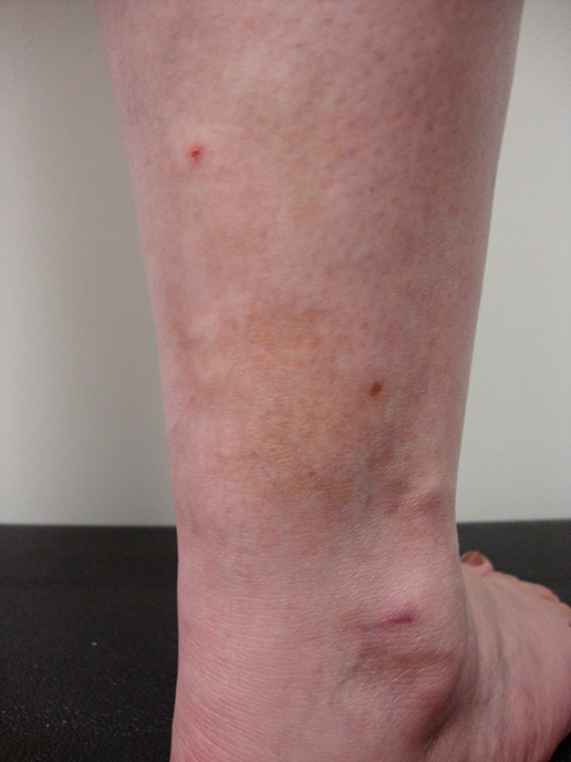 Photo of Stasis-Dermatitis after Sclerotherapy