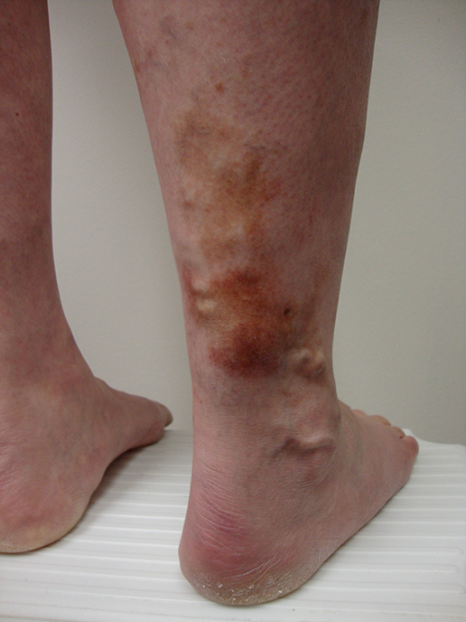 Photo of Stasis-Dermatitis before Sclerotherapy