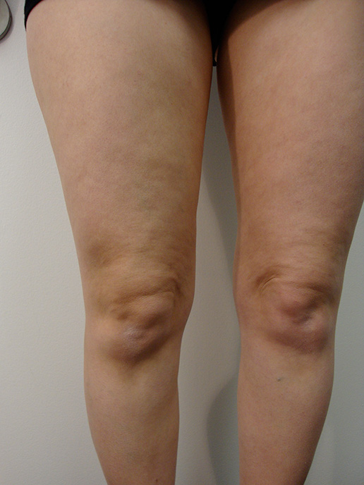 Photo of varicose veins after Sclerotherapy