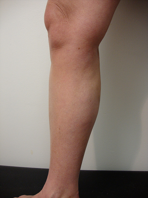 Photo of varicose veins after Sclerotherapy