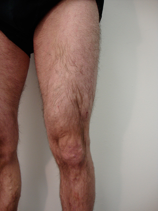 Photo of varicose veins after Sclerotherapy