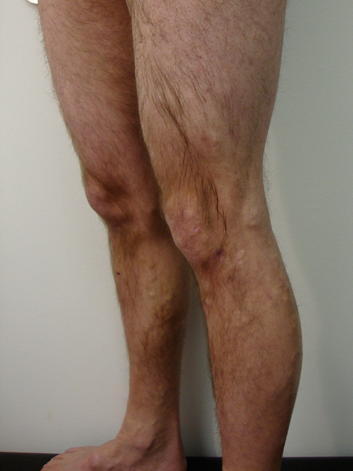 Photo of varicose veins after Sclerotherapy