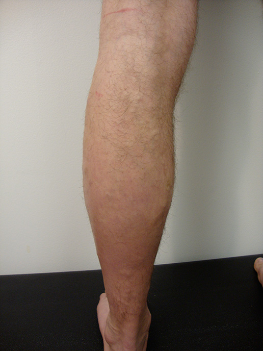 Photo of varicose veins after Sclerotherapy