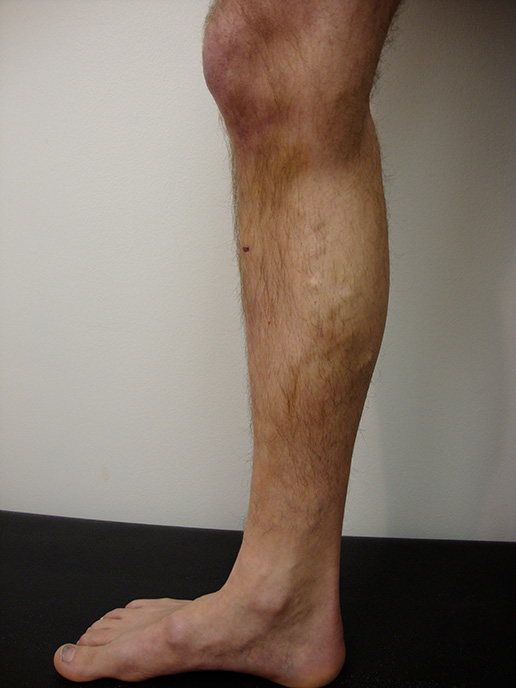 Photo of varicose veins after Sclerotherapy