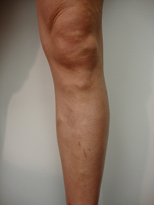 Photo of varicose veins after Sclerotherapy