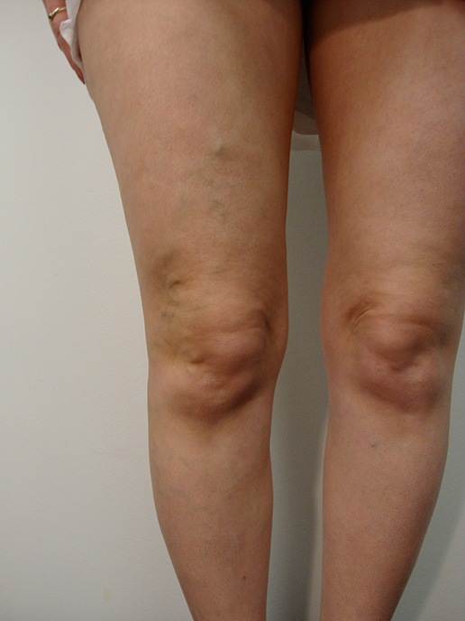 Photo of varicose veins before Sclerotherapy