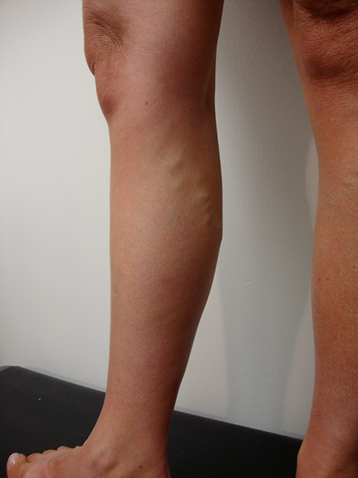 Photo of varicose veins before Sclerotherapy