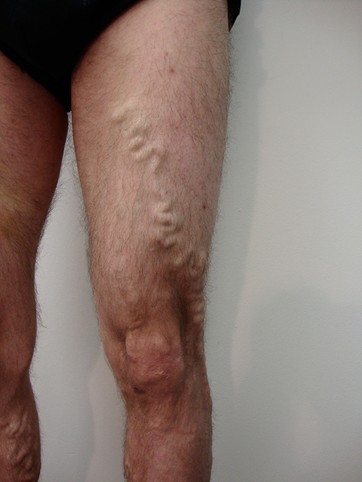 Photo of varicose veins before Sclerotherapy