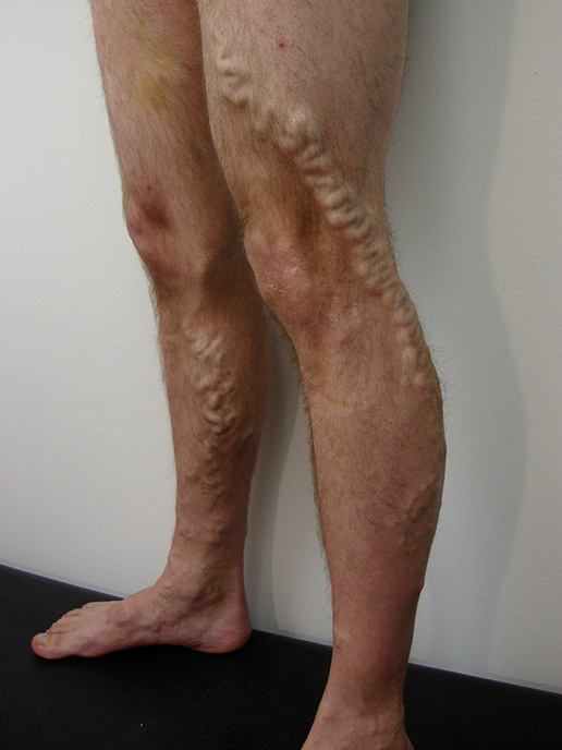 Photo of varicose veins before Sclerotherapy