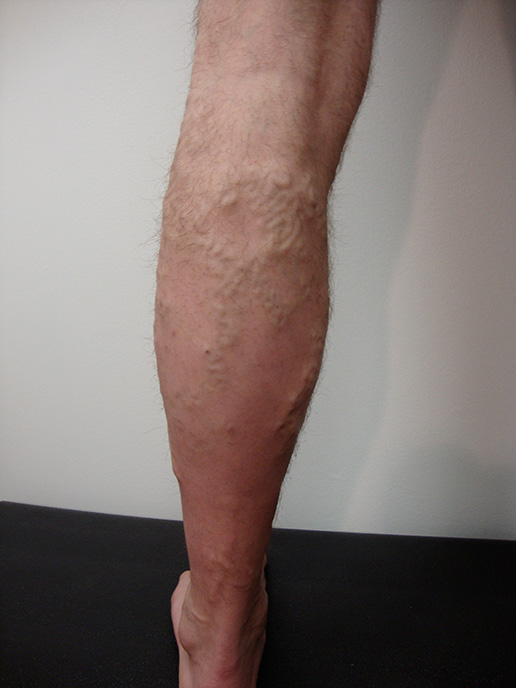 Photo of varicose veins before Sclerotherapy