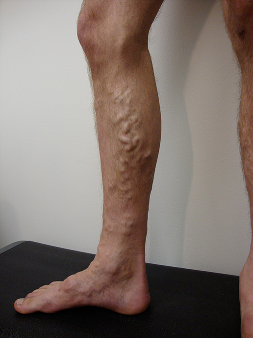 Photo of varicose veins before Sclerotherapy