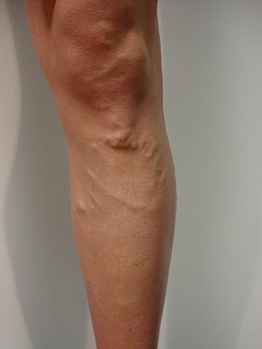 Photo of varicose veins before Sclerotherapy