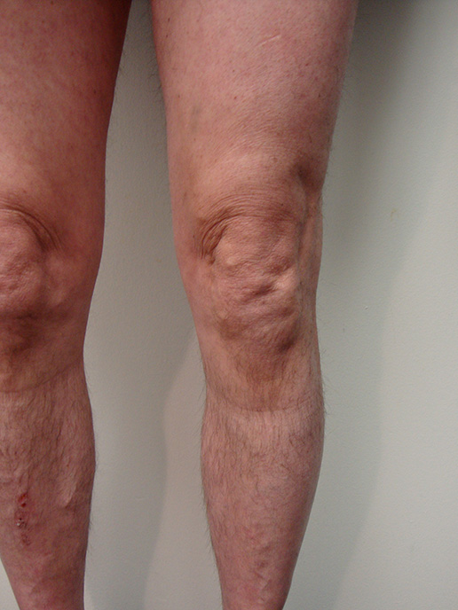 Photo of varicose veins after Sclerotherapy