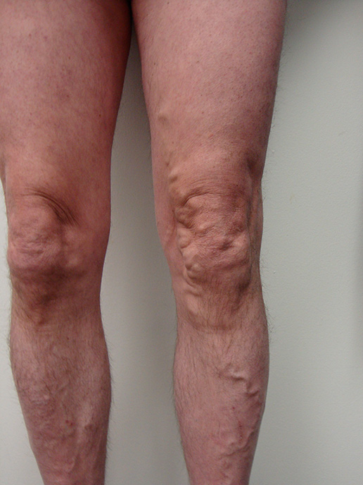 Photo of varicose veins before Sclerotherapy