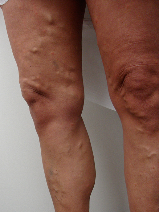 Photo of varicose veins before Sclerotherapy