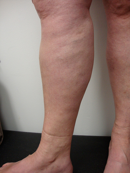 Photo of varicose veins after Sclerotherapy