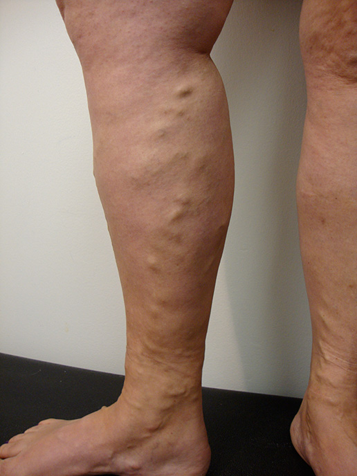 Photo of varicose veins before Sclerotherapy