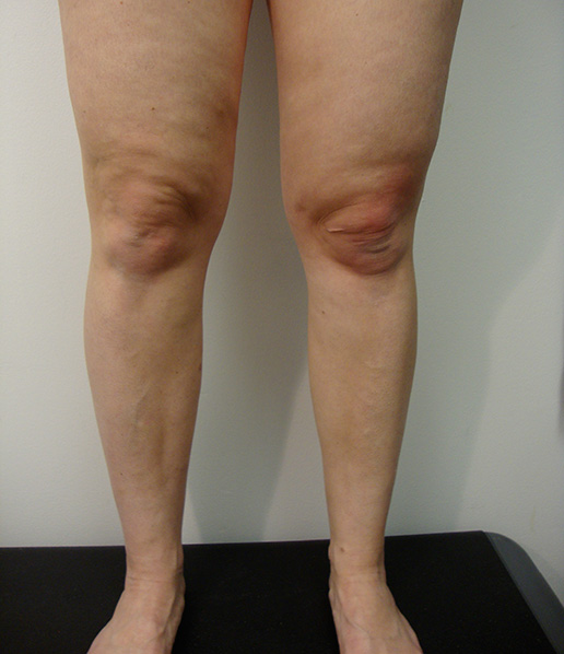 Photo of varicose veins on thigh after Sclerotherapy