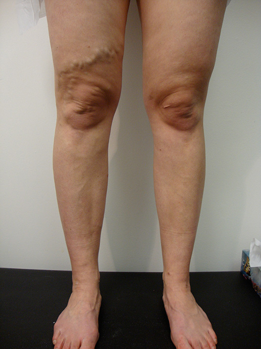 Photo of varicose veins on thigh before Sclerotherapy