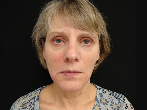 Cheeks, Temples, Under Eyes and Marionette Lines after Dermal Filler