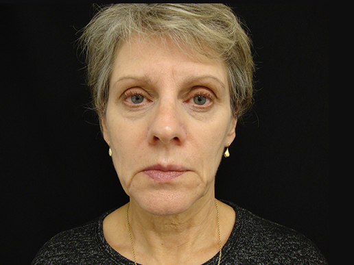 Cheeks, Temples, Under Eyes and Marionette Lines before Dermal Filler