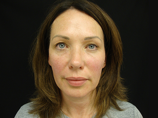 Cheeks and Under Eyes after Dermal Filler