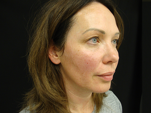 Cheeks and Under Eyes after Dermal Filler