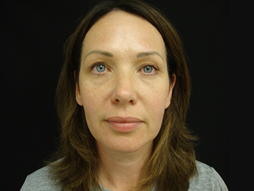 Cheeks and Under Eyes before Dermal Filler