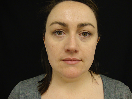 Tear Troughs Before Dermal Filler