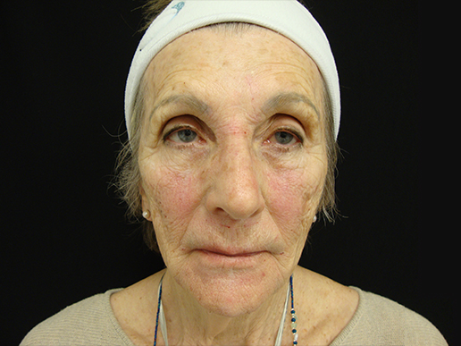 Upper, Mid, Lower Face After Dermal Fillers