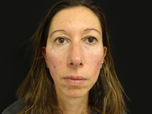 Dermal Filler - Cheeks, under eyes, and tear troughs - after