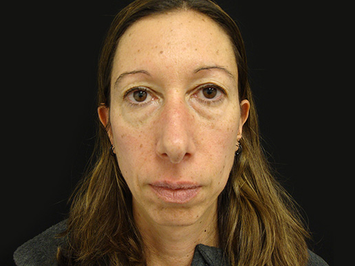 Dermal Filler - Cheeks, under eyes, and tear troughs - before