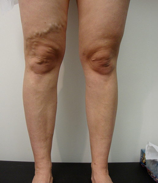 Photo of varicose veins on thigh before Sclerotherapy